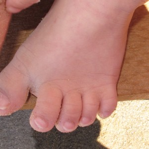 toe gap